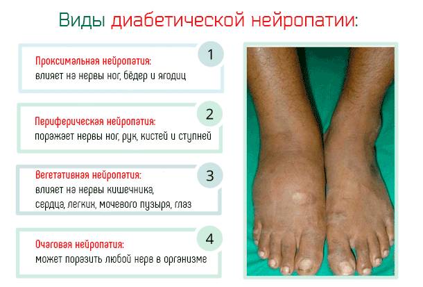 Диабетическая нейропатия