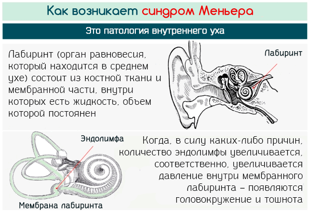 Синдром Меньера