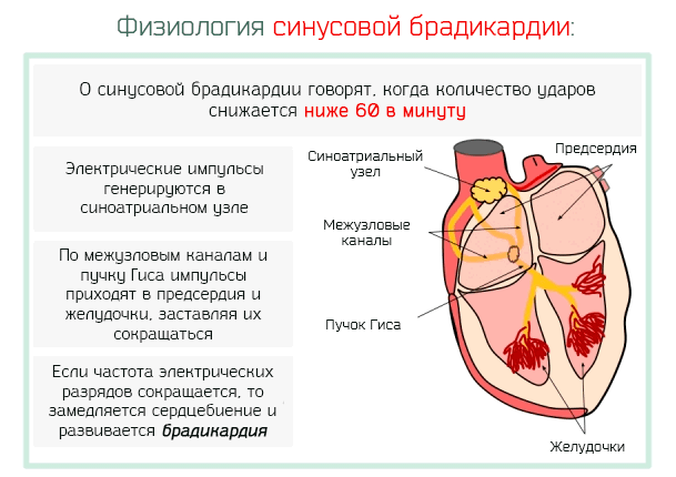 Брадикардия