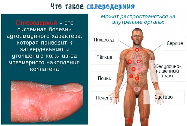 Склеродермия