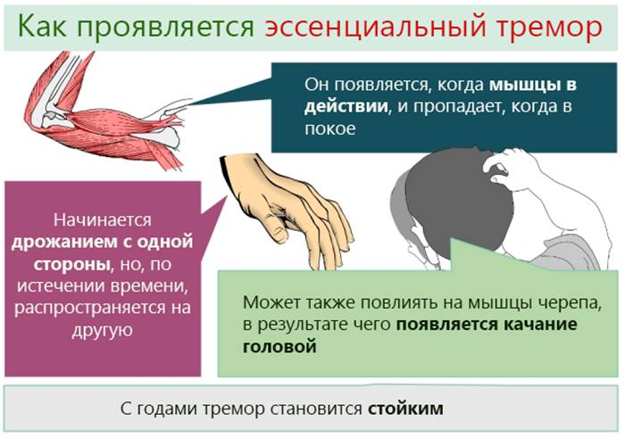 Синдром Минора