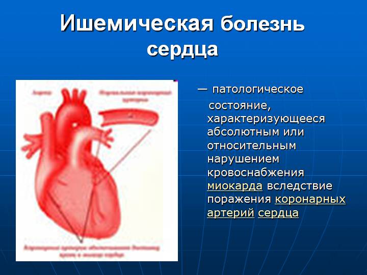 ИБС