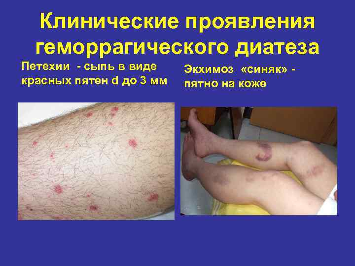 Геморрагический диатез