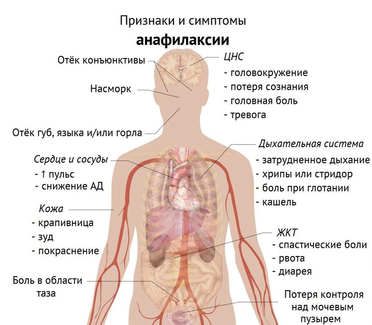 Анафилаксия