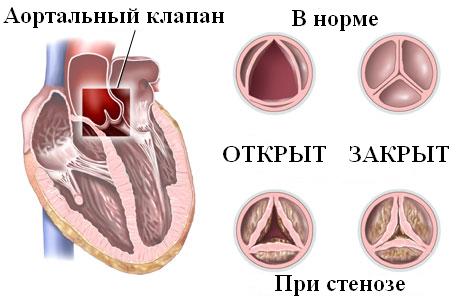 Стеноз аортального клапана