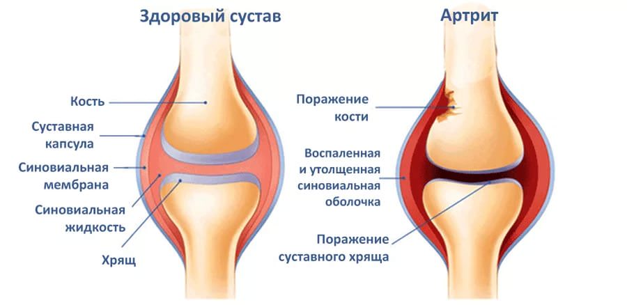 Артрит