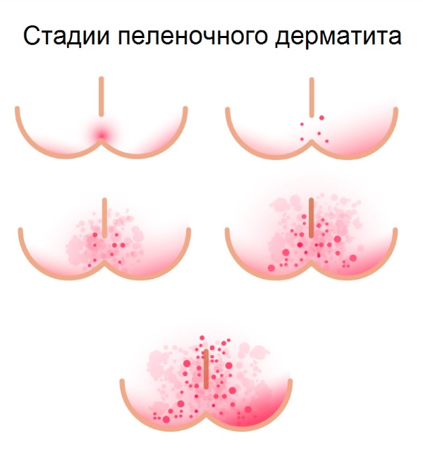 Пеленочный дерматит