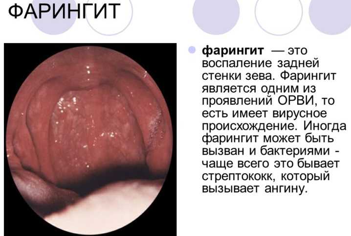Фарингит