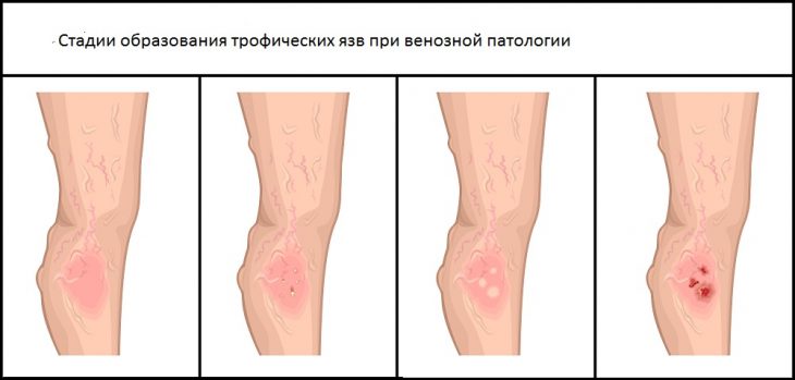 Трофическая язва