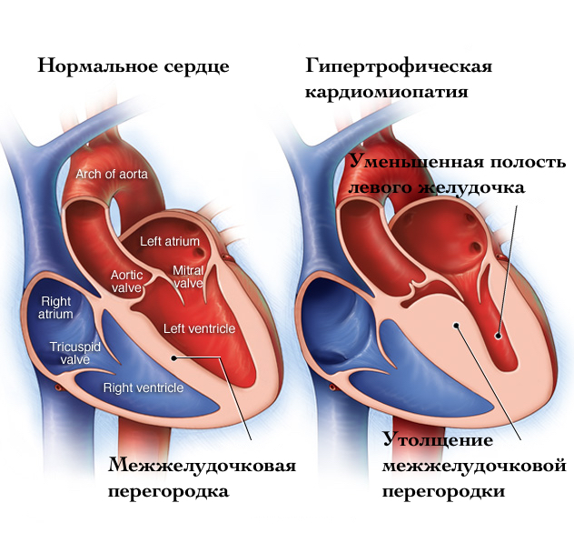Гипертрофическая кардиомиопатия