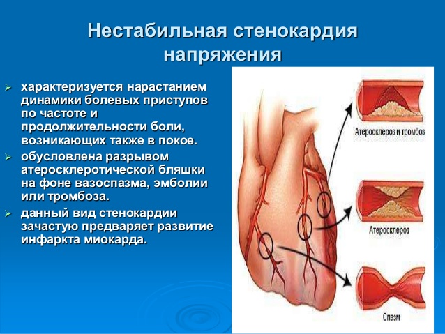 Нестабильная стенокардия