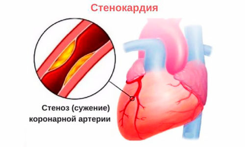 Стенокардия