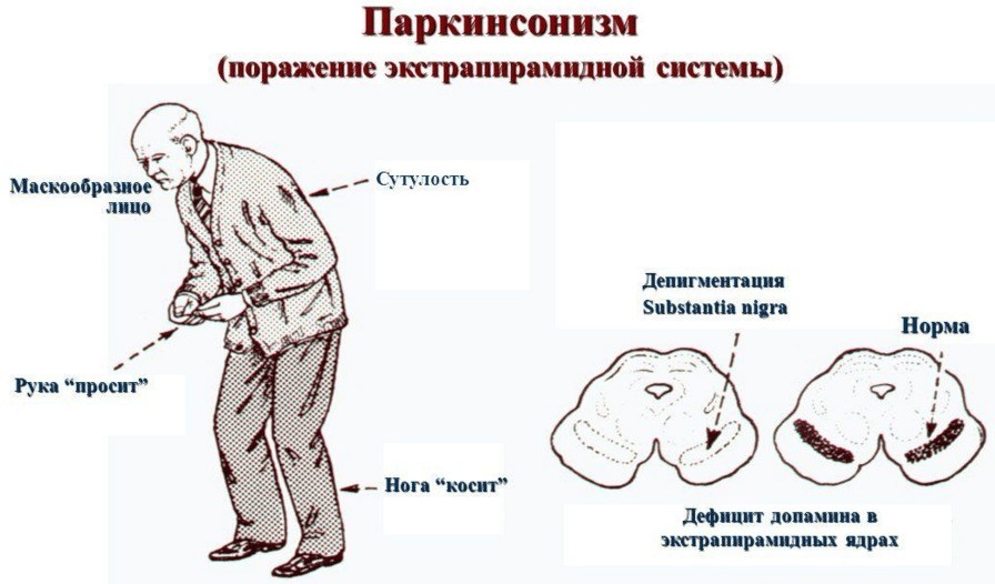 Паркинсонизм
