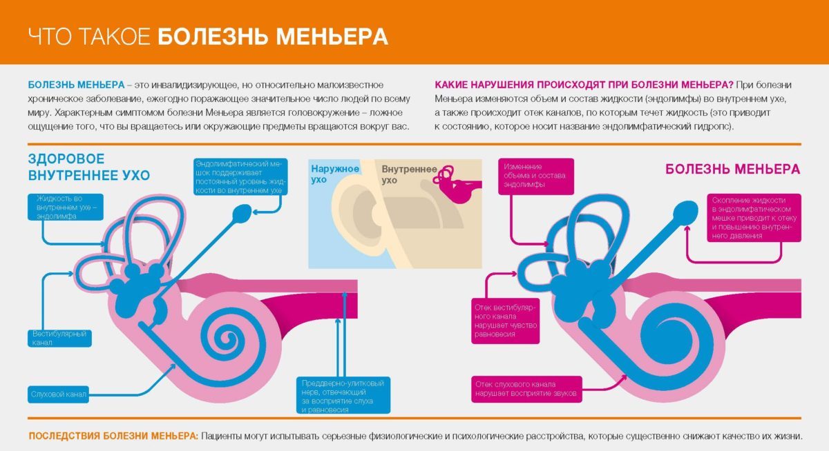 Болезнь Меньера