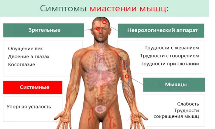 Миастения