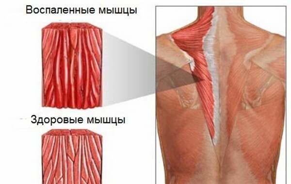 Миозит