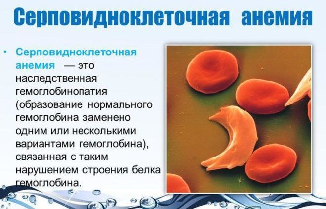 Серповидноклеточная анемия