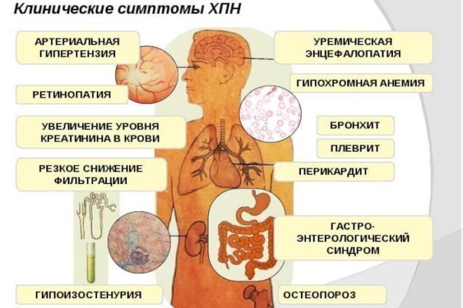 Почечная недостаточность