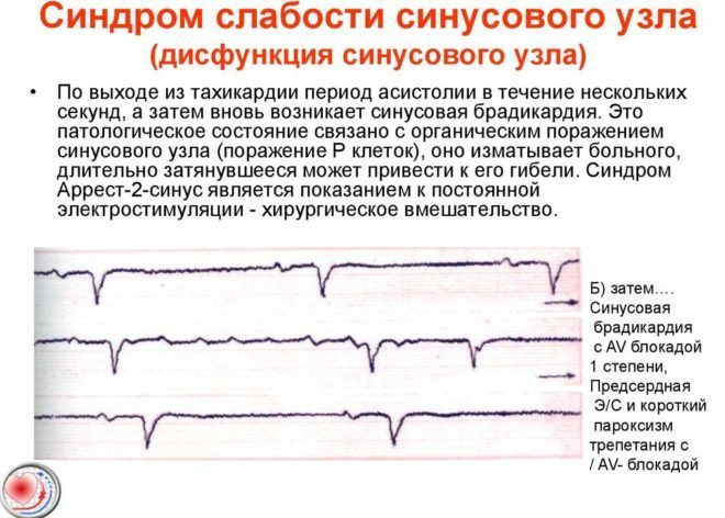Синдром слабости синусового узла
