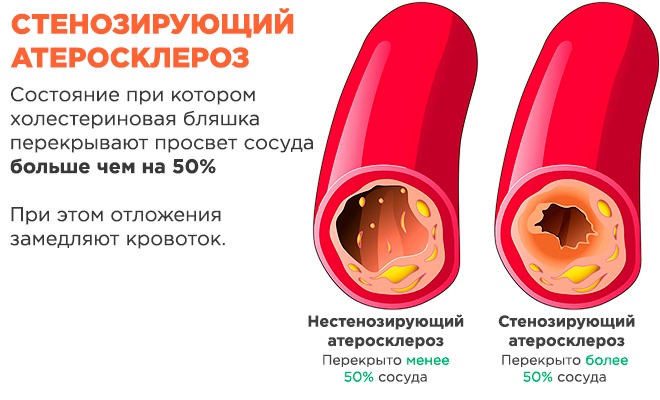 Стенозирующий атеросклероз