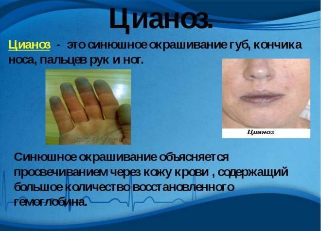 Цианоз