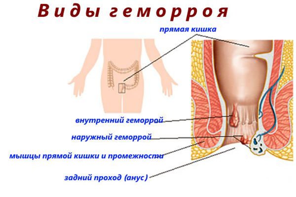 Виды геморроя