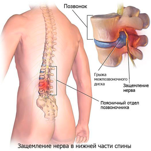 Люмбалгия