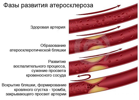 Атеросклероз