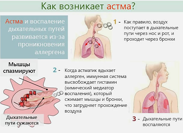 Бронхиальная астма
