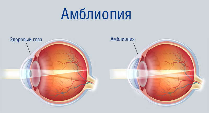 Амблиопия