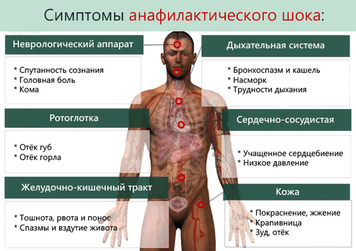 Симптоматика анафилактического шока