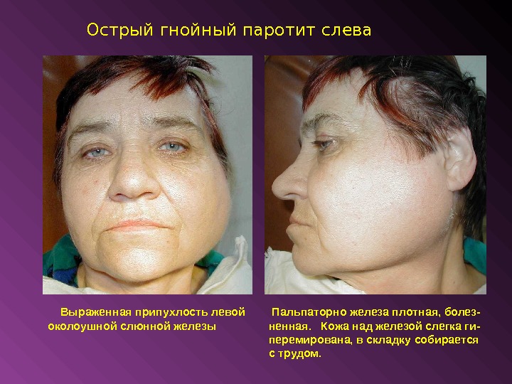 Гнойный паротит