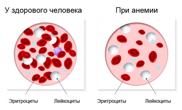 Анемия