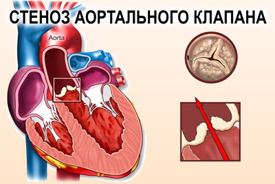 Аортальный стеноз