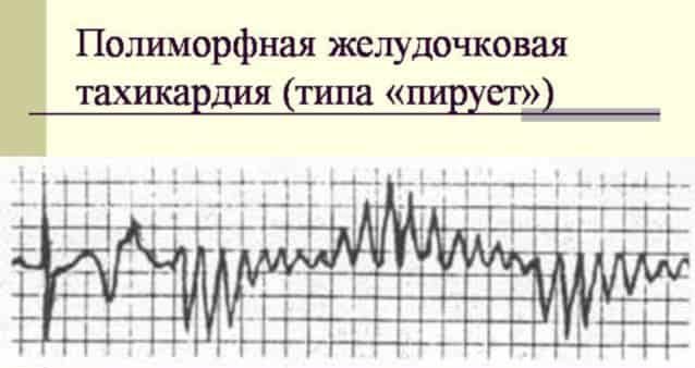 Аритмия пируэт
