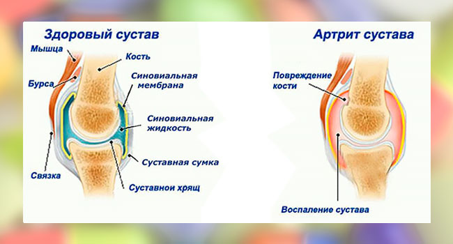 Артрит