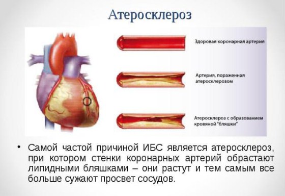 Атеросклероз коронарных сосудов