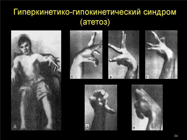 Атетоз