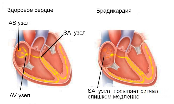 Брадикардия