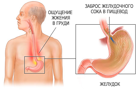 Рефлюкс-эзофагит