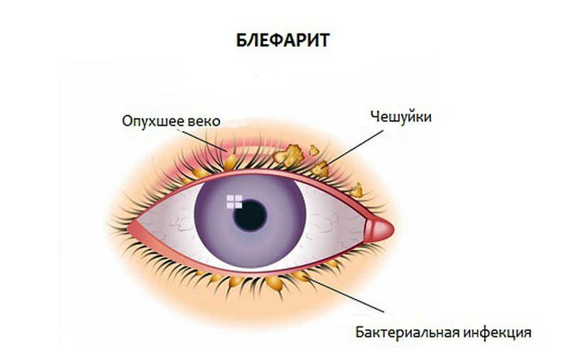 Блефарит