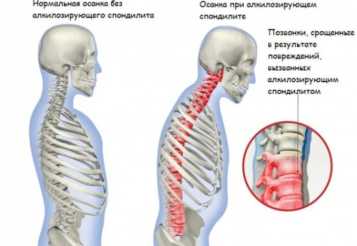 Спондилит