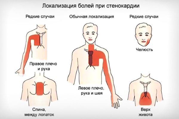 Стенокардические боли