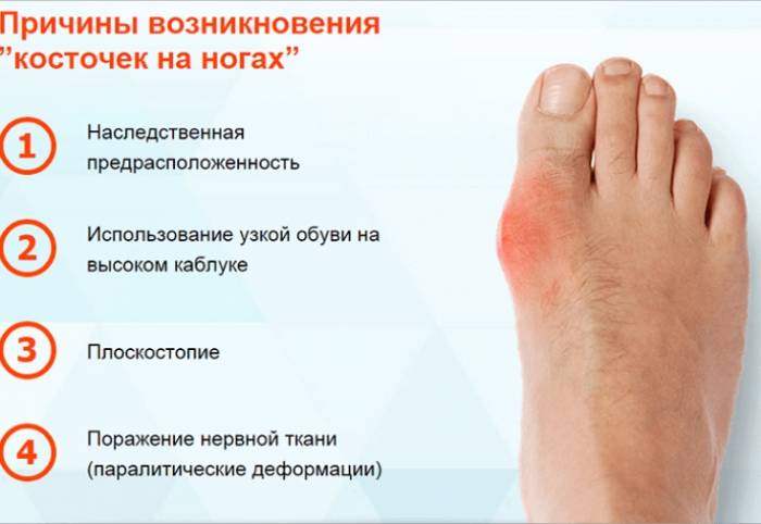 Причины бурсита