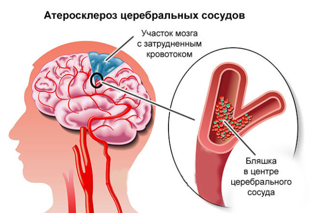 Церебральный атеросклероз сосудов мозга