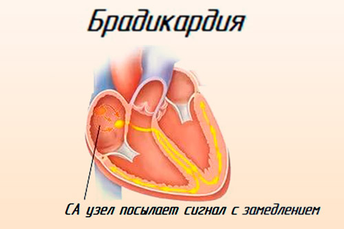 Брадикардия