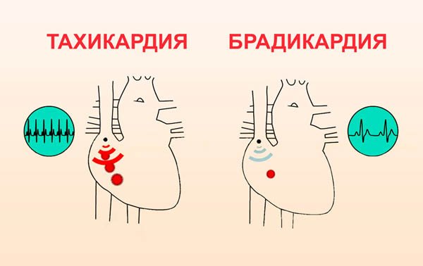Брадикардия