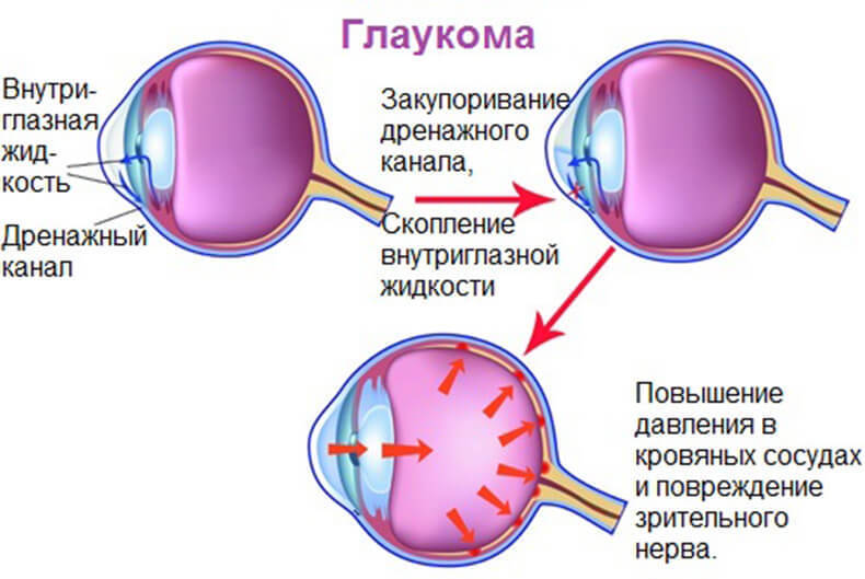 Глаукома