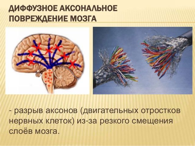 Повреждение мозга