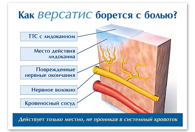 Версатис
